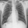 Dextrocardia