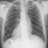 Dextrocardia