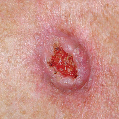 skin-cancer-carcinoma-400x400.jpg