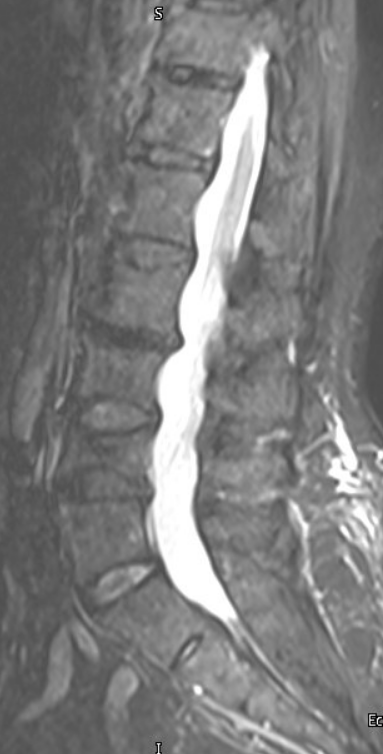 02-19-2023 STIR MRI Image.PNG