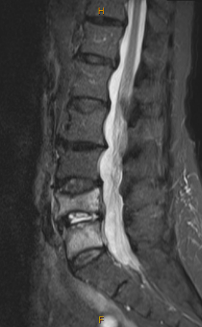 06-09-2023 STIR MRI Image.PNG