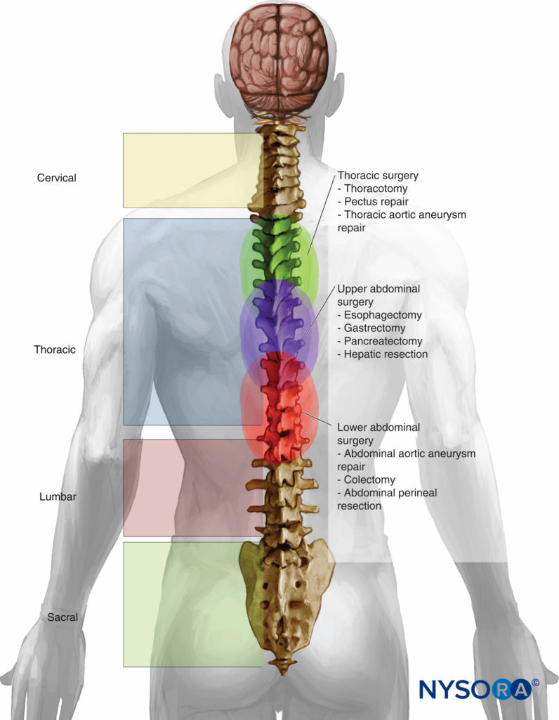 Esophagectomy epidural Student Doctor Network