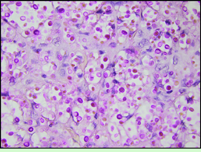 A-histologic-section-demonstrated-oval-thickwalled-encapsulated-spherules-that-were.png