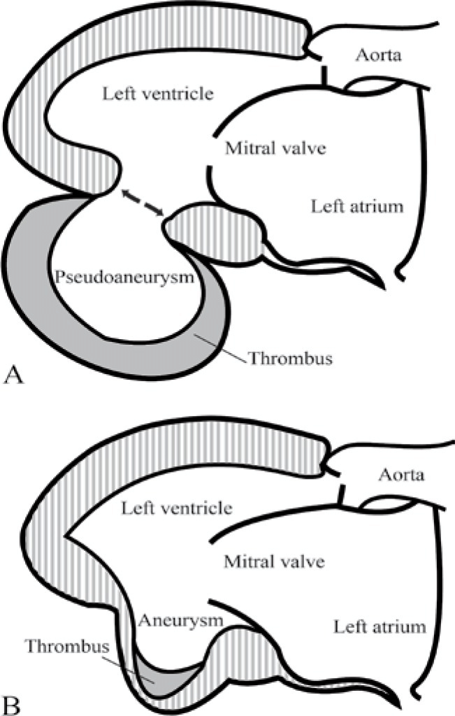 A-posterior-wall-pseudoaneurysm-A-versus-a-true-aneurysm-B-LV-Left-ventricle-LA (1).png