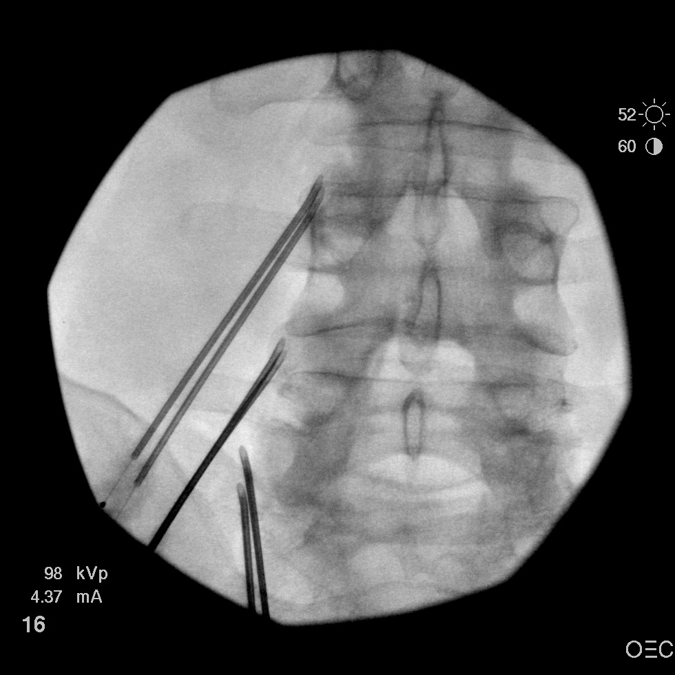 Is anyone doing this two needle technique for RFA? | Student Doctor ...