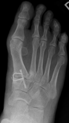 BadBunion - Copy.JPG