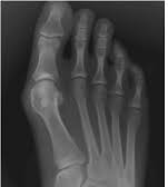 Bunion-Met-adductus.png