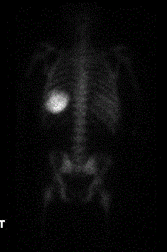 cerv disc 11 21 bone scan pre.GIF