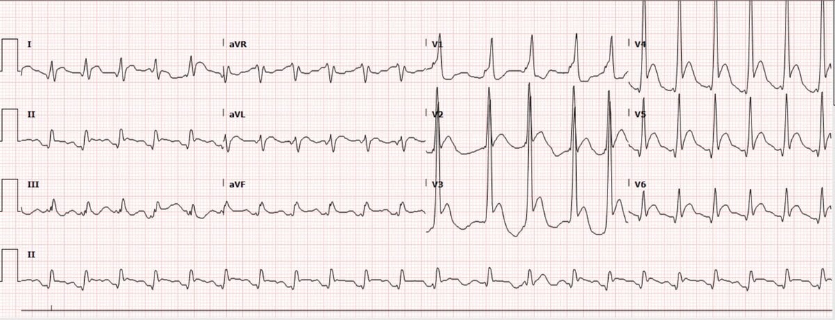 CPR EKG.jpg