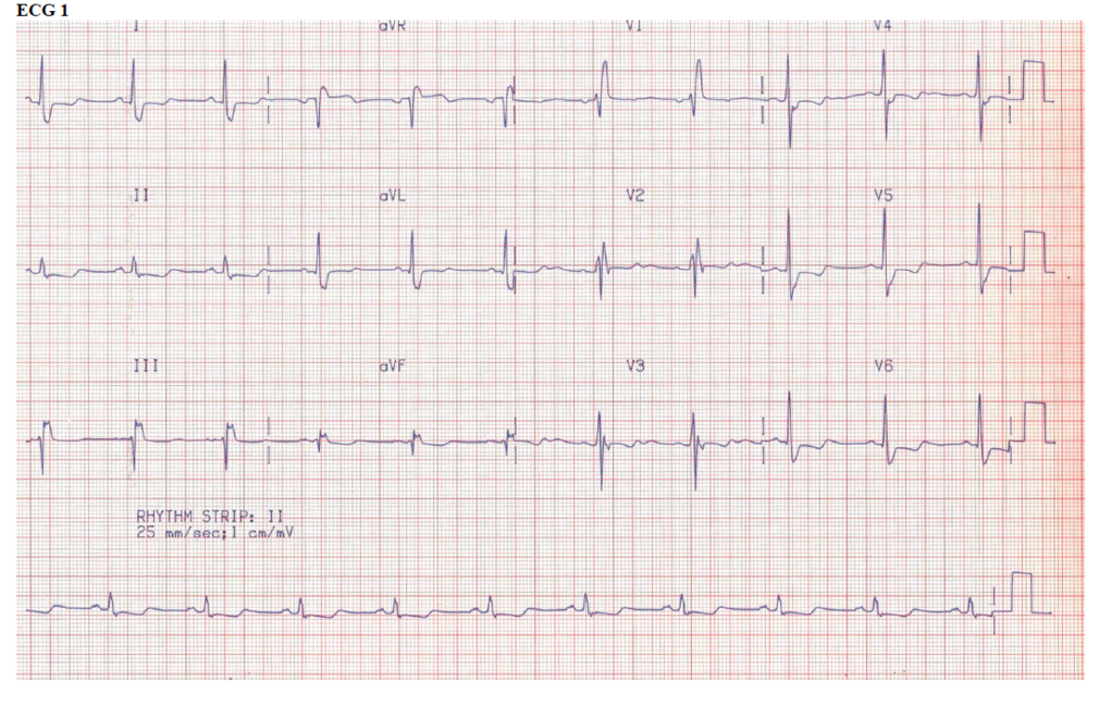 ECG 1.png