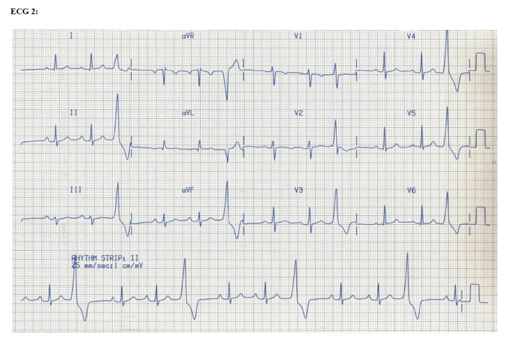 ECG 2.png