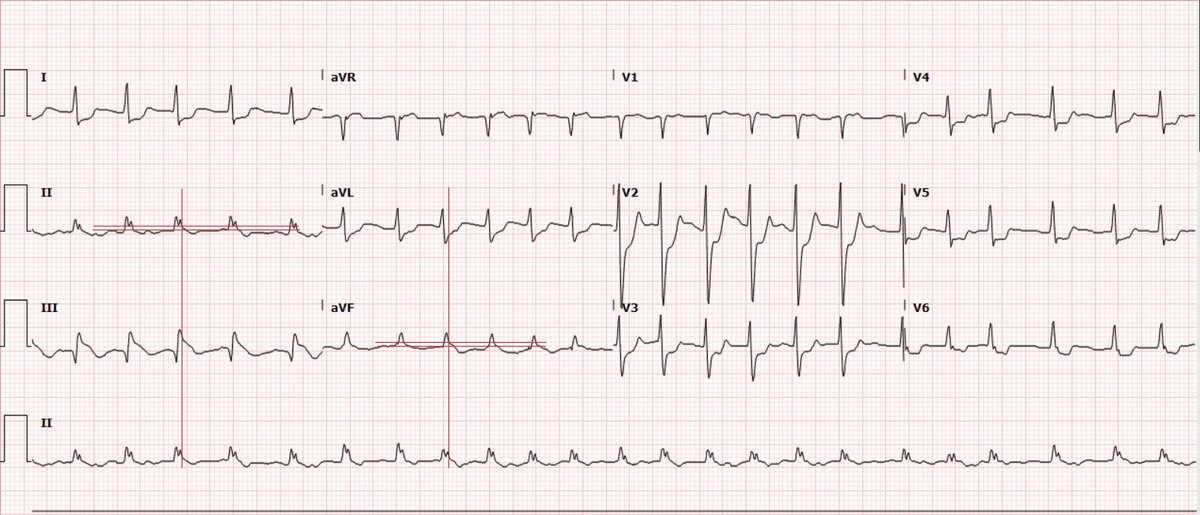 EKG Annotated.jpg