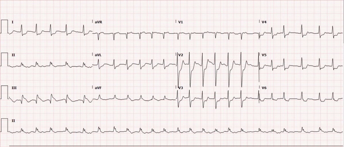 EKG.jpg