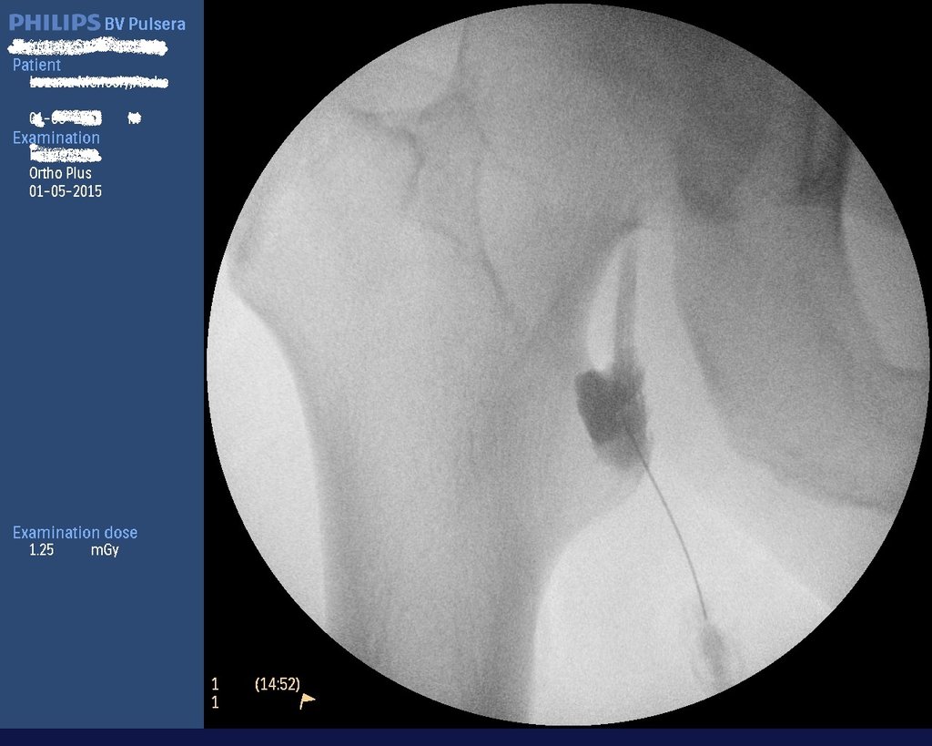 iliopsoas bursa.jpg