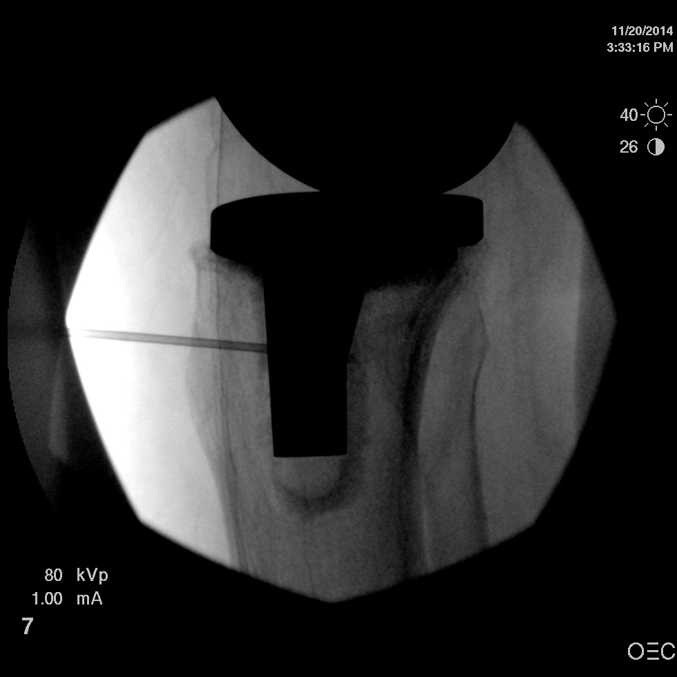Genicular nerve- conventional RF | Student Doctor Network Forums