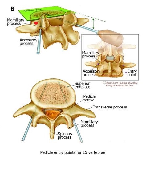 InkedL5 Pedicle entry_LI.jpg