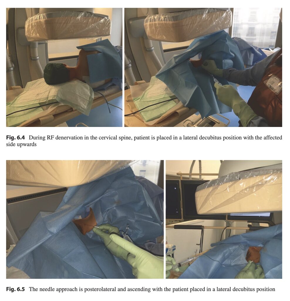 I need cervical medial branch block and radiofrequency ablation pearls ...
