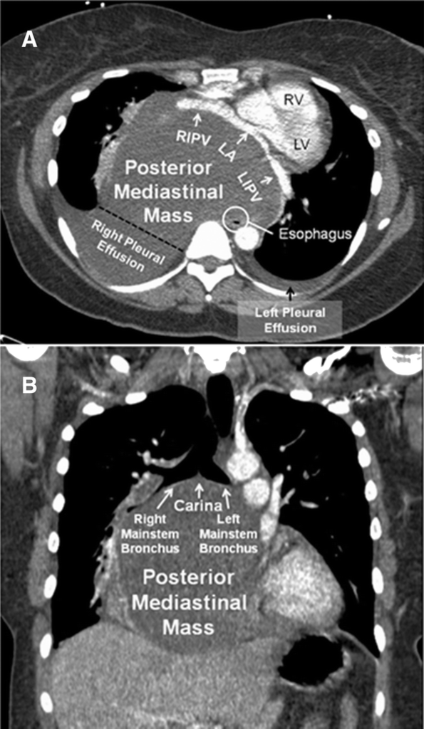 Mediastinal mass.png