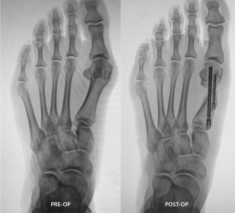 mis-4-x-ray-before-and-after.jpeg
