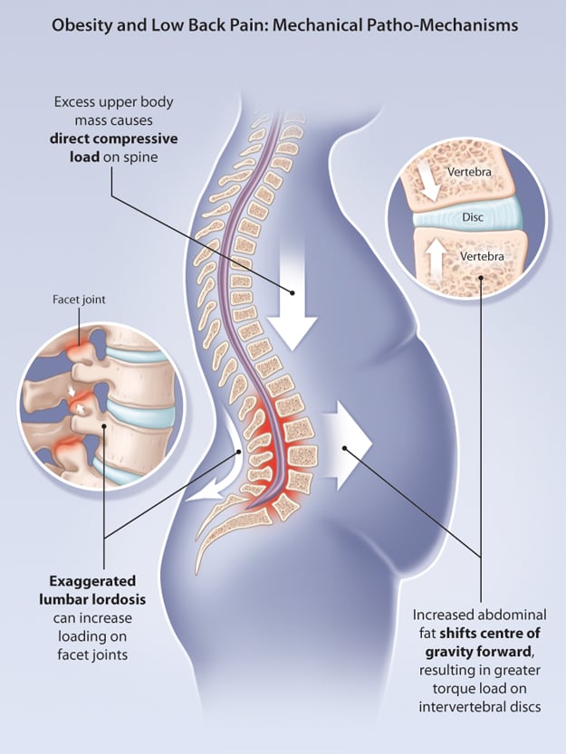 obesity-and-low-back-pain.jpg