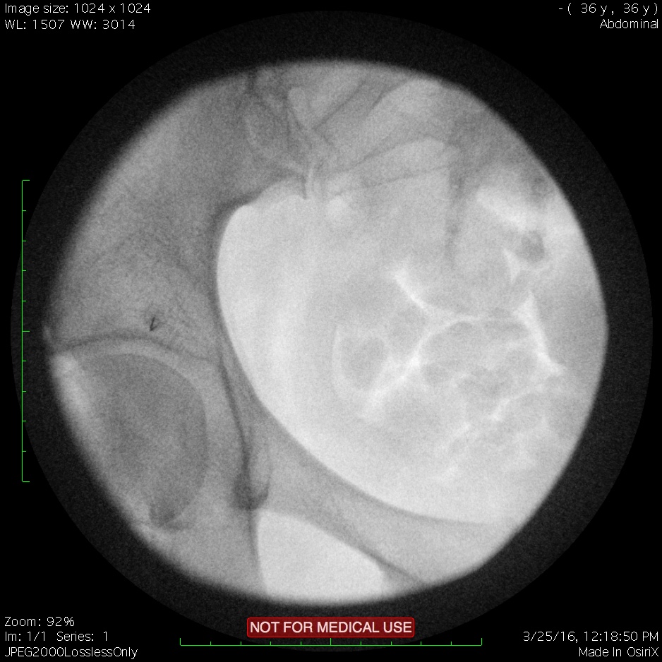 Piriformis 1.jpg