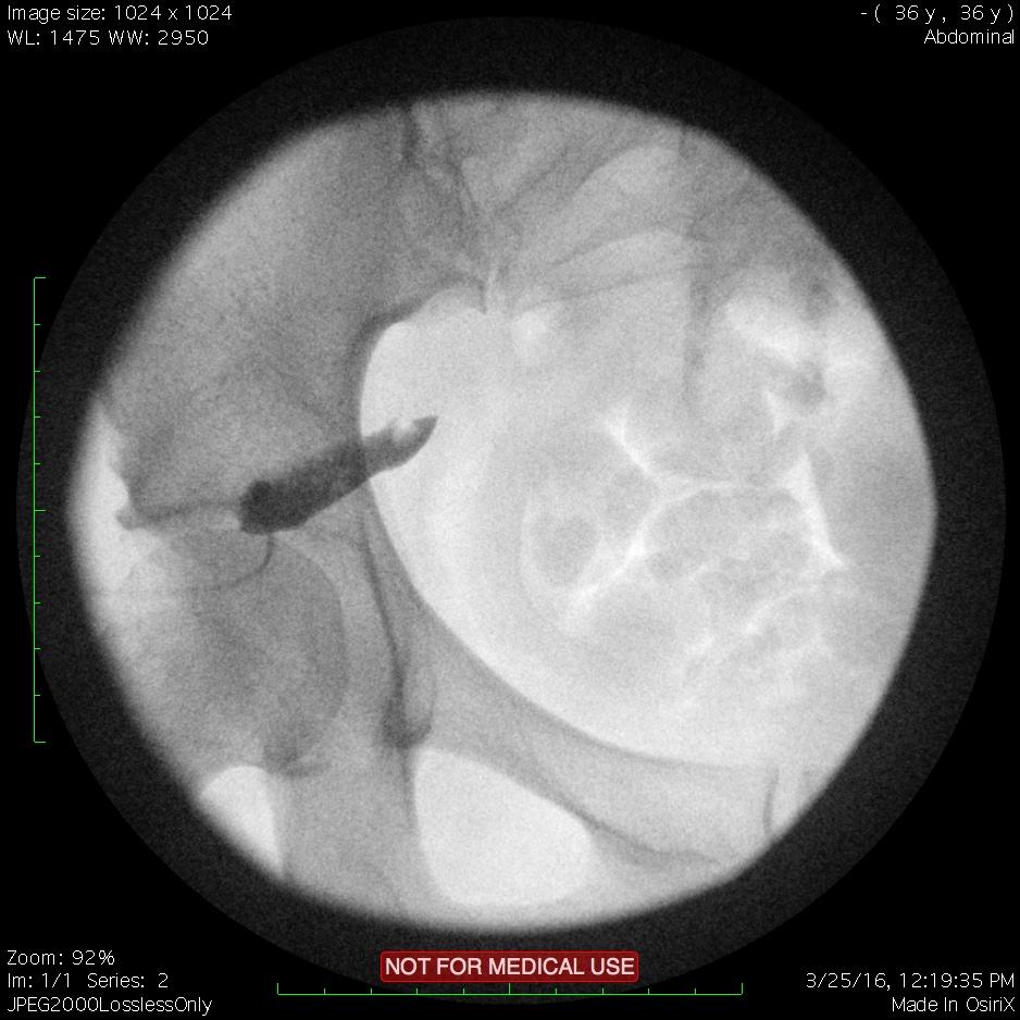 Piriformis 2.jpg