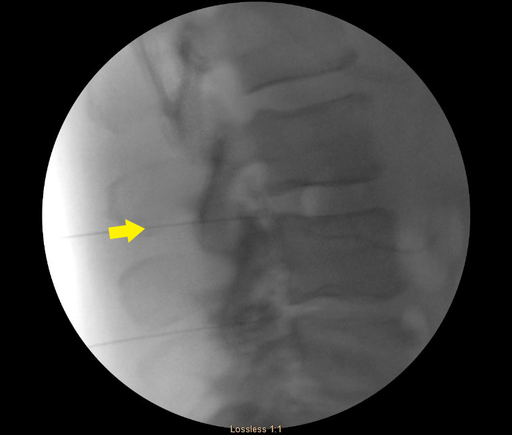 Retrodiscal RM Artery-Edit.png