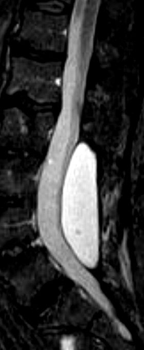 seroma.jpg