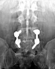 Neuraxial in patient with Harrington rods | Student Doctor Network Forums