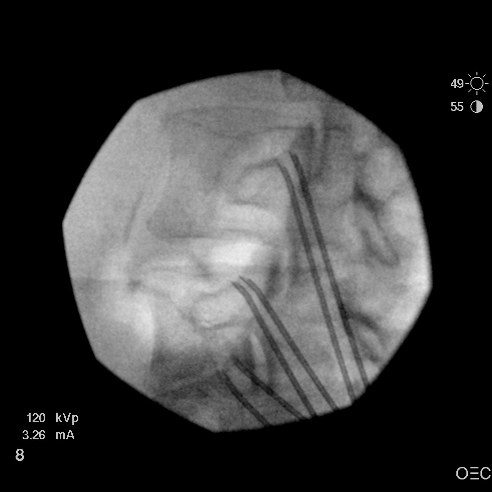 Is anyone doing this two needle technique for RFA? | Student Doctor ...