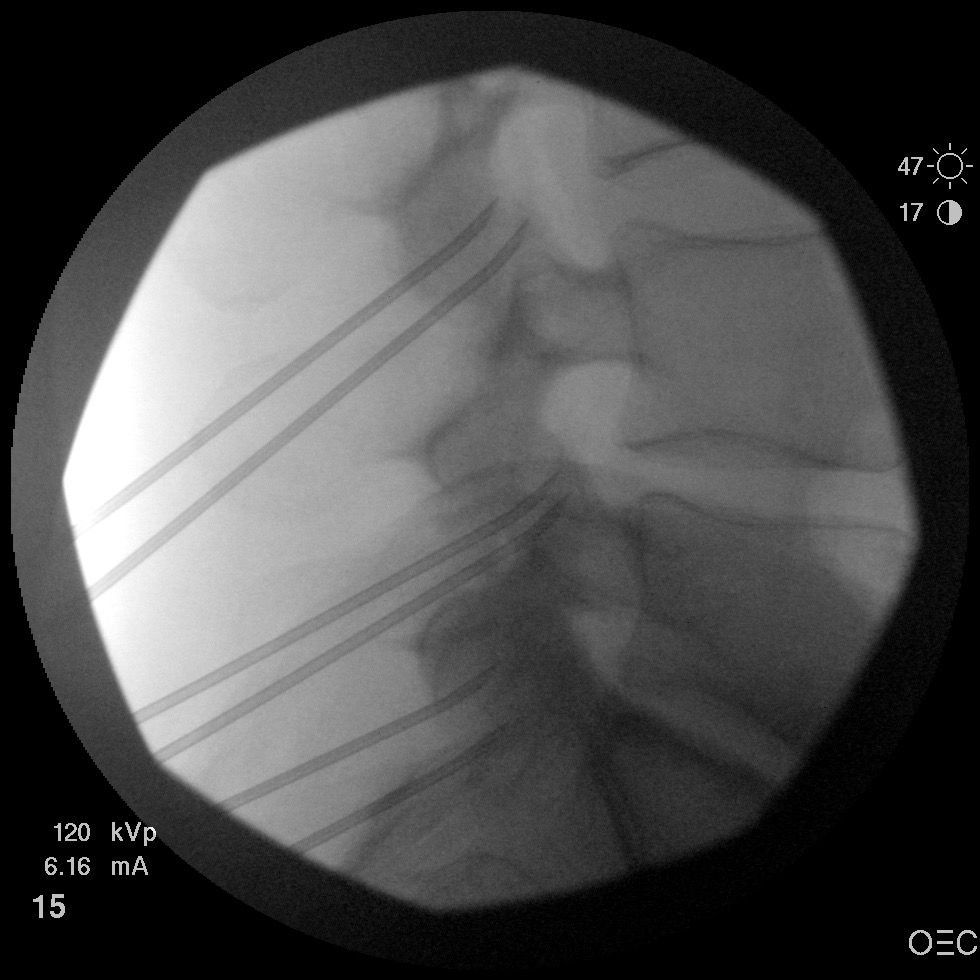 Is anyone doing this two needle technique for RFA? | Student Doctor ...