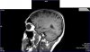 HLP AL sagittal L24.8.jpg