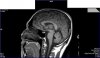 HLP AL sagittal R1.2.jpg