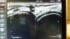 gastroc tendon.jpg