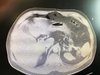 Abdominal mass.jpg