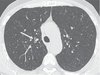 Example COPD smoker.jpg