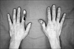 Hand_Necrosis.jpg Hand_Necrosis.jpg