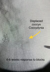 coccyx rfa.jpg