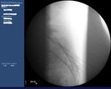 sacral lat rf lat.jpg
