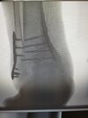 ankle varus orif.jpg