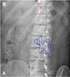 thoracic oblique parapedicular.jpg