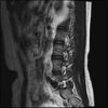 LUMBAR SPINE WITHOUT CONTRAST 0004.jpg