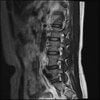 LUMBAR SPINE WITHOUT CONTRAST 0005.jpg
