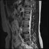 LUMBAR SPINE WITHOUT CONTRAST 0006.jpg