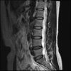 LUMBAR SPINE WITHOUT CONTRAST 0007.jpg