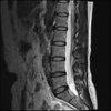 LUMBAR SPINE WITHOUT CONTRAST 0008.jpg