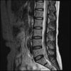 LUMBAR SPINE WITHOUT CONTRAST 0010.jpg
