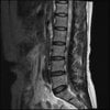 LUMBAR SPINE WITHOUT CONTRAST 0011.jpg
