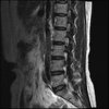 LUMBAR SPINE WITHOUT CONTRAST 0012.jpg