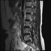 LUMBAR SPINE WITHOUT CONTRAST 0013.jpg